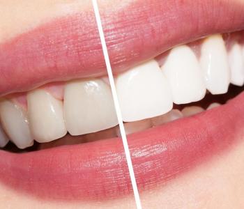 Teeth Whitening