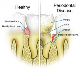 Periodontitis Complications