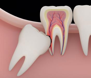 Wisdom Tooth Extractions