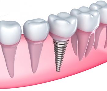 Dental Implant Placement