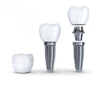 Dental Implant Restoration