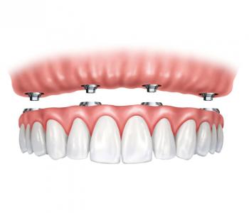 Implant Supported Dentures