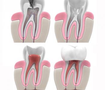 Root Canals